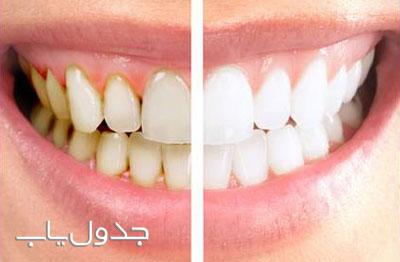 سفید کننده دندان‌