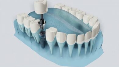 مراقبت بعد از ارتودنسی دندان: چه بخوریم و چگونه آن را تمیز کنیم؟